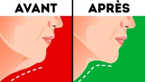 Double Menton et Ovale du Visage : Comprendre et Traiter ces Phénomènes Esthétiques
